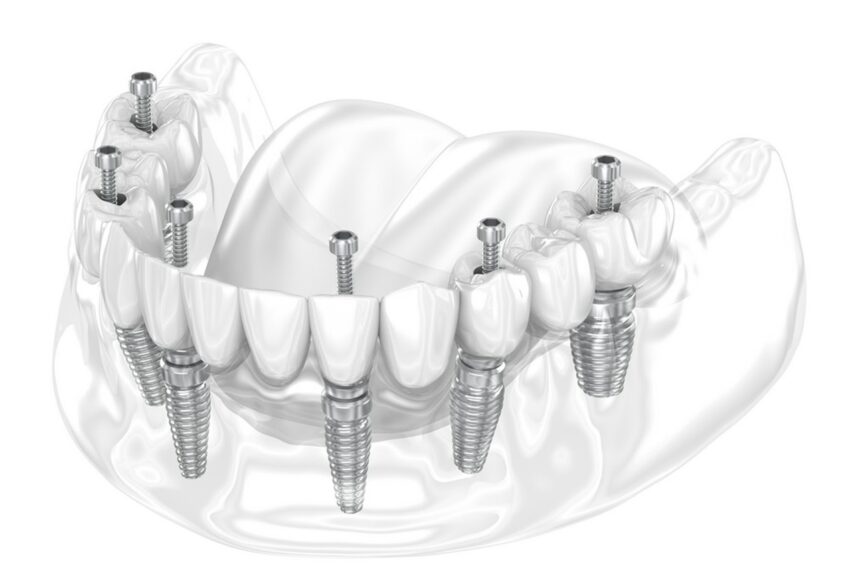 Wykonanie protezy na 4 implantach - jak to wygląda w praktyce?