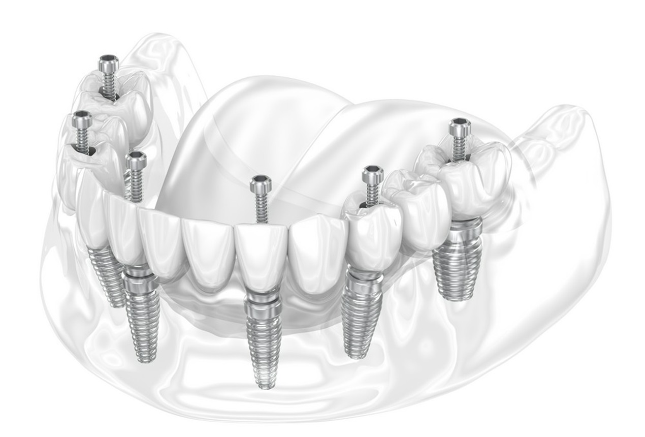 Wykonanie protezy na 4 implantach – jak to wygląda w praktyce?